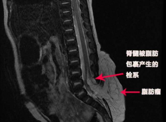 當(dāng)心嬰兒尾骨處的異常現(xiàn)象 鼓包、小坑、多毛可能脊柱有大問題