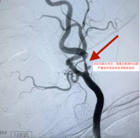 頸內(nèi)動脈支架術中栓子脫落太多險象環(huán)生 專家巧妙化解