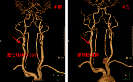 30年老煙槍頸動(dòng)脈重度狹窄 小切口解決大“堵塞”