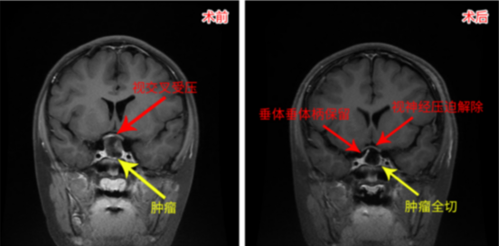 醫(yī)生媽媽：我要給我孩子找最好的顱咽管瘤手術(shù)團(tuán)隊