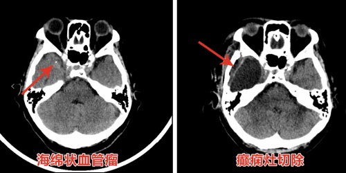  海綿狀血管瘤繼發(fā)癲癇20年  三博腦科精準(zhǔn)外科為古稀老人徹底止“抽”