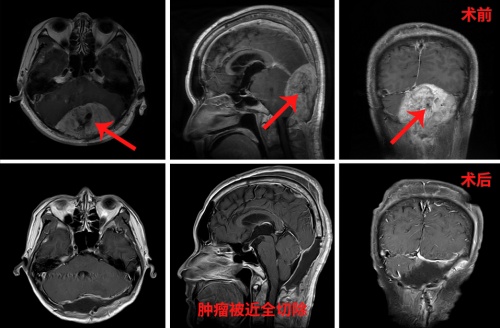  分站式復(fù)合手術(shù)切除鵝蛋般大小腦轉(zhuǎn)移瘤  三博腦科讓腎癌腦轉(zhuǎn)移瘤患者蝶變重生