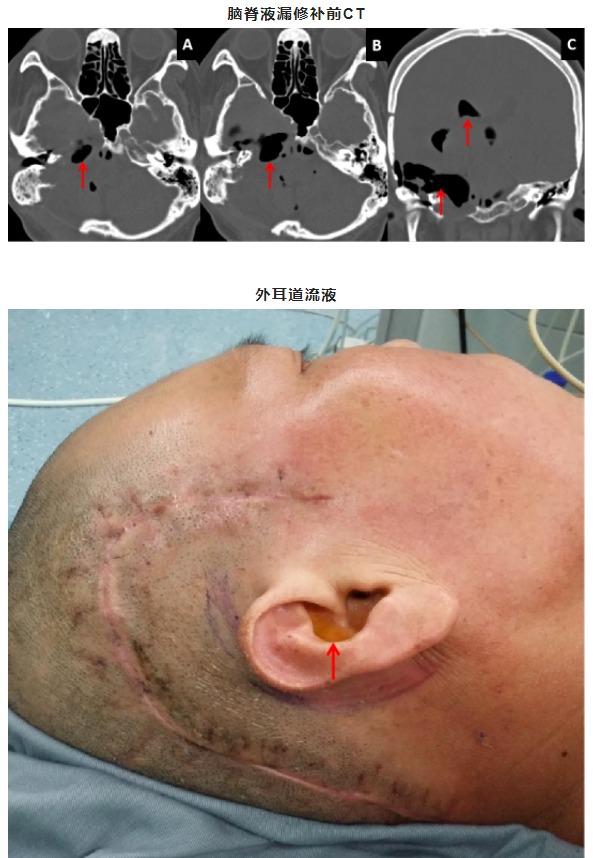 專訪首都醫(yī)科大學(xué)三博腦科醫(yī)院-張明山教授-側(cè)顱底腫瘤手術(shù)入路選擇探討